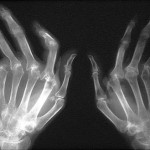 Che cibi evitare se soffrite di artrite reumatoide