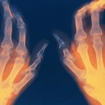 Il ruolo della dieta nell’artrite reumatoide